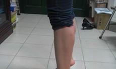 Phẫu thuật nội soi chấn thương khớp phức tạp