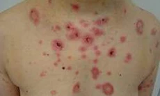 Một số loại thuốc gây bệnh hồng ban