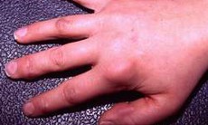 Cảnh giác với bệnh viêm khớp tự phát thiếu niên