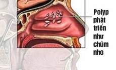 Polyp mũi có nguy hiểm?