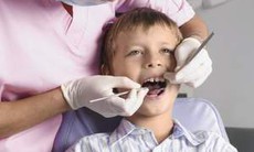 Sâu răng - Đừng chủ quan!