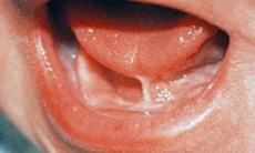 Dính thắng lưỡi ở trẻ