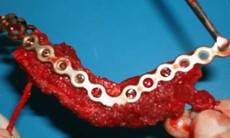 Tái tạo xương hàm mặt bằng vi phẫu
