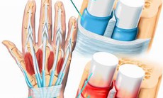 Đau cổ tay và hội chứng De Quervain