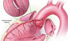 Phương pháp màu nhiệm xử trí bệnh cơ tim phì đại