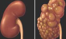 Bệnh thận đa nang điều trị thế nào?