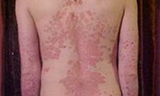 Lupus ban đỏ - “căn bệnh lạ”?