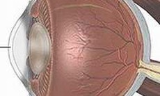 Glaucoma bẩm sinh chữa cách gì?