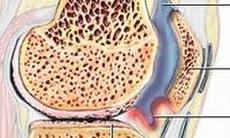 Điều trị tràn dịch khớp gối