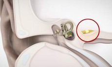 Mất thính giác dẫn truyền