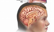 Phòng bệnh viêm màng não do não mô cầu