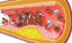 Cách nhìn mới về xơ vữa động mạch