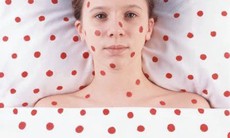 Sốt phát ban do vi rút Rubella: Gia tăng ở người lớn