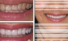 Chữa răng ố vàng, cách nào?