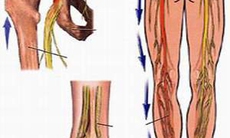 Chữa đau thần kinh tọa bằng thuốc Đông y