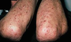 Viêm da dạng Herpes có nguy hiểm?