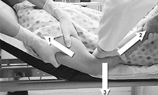 Trật khớp khuỷu có thể gây tàn tật
