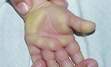 Dày sừng lòng bàn tay, bàn chân và cách trị