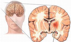 Xuất huyết não: Một nguyên nhân tử vong bất thường