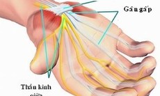 Hội chứng đường hầm cổ tay