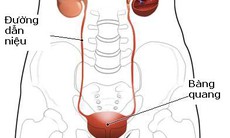 Viêm đường tiết niệu và thuốc dùng