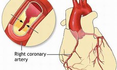 Can thiệp tim mạch cứu sống bệnh nhân không thể phẫu thuật