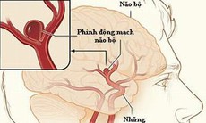 Điều trị dị dạng mạch máu não