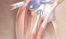 Tiêm corticoid tại chỗ - Lợi và hại