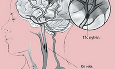 Rối loạn tuần hoàn não và cách phòng tránh