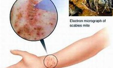Thuốc trị bệnh ghẻ