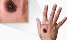 Bệnh than ở người: Nhiễm khuẩn từ gia súc
