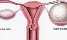 5 kiểu đau bụng phụ nữ cần lưu ý