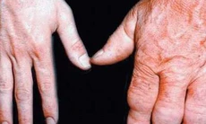 Ai có thể mắc bệnh to đầu chi?