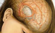 Dị tật bẩm sinh đi đôi với các khối u não ở trẻ em