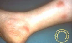 Hồng ban rắn Bazin dễ nhầm với nhiều bệnh khác