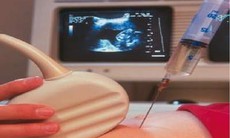 Phương pháp mới chẩn đoán thai nhi nhiễm Rubella