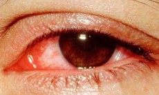 Trị bệnh viêm mủ nội nhãn