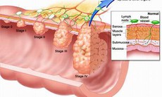 Folate giảm nguy cơ mắc ung thư ruột kết