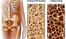 Cẩn thận, thuốc gây... loãng xương