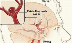 Ðiều trị bệnh dị dạng động tĩnh mạch não
