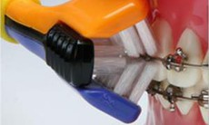 Bí quyết vệ sinh răng miệng khi nắn chỉnh răng