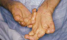 Đẩy nhanh tốc độ loại trừ bệnh phong