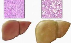 Gan nhiễm mỡ làm sao tránh được?