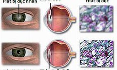 Chăm sóc mắt sau phẫu thuật