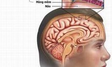  Nhận biết viêm màng não do não mô cầu