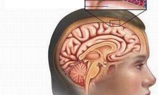 Cảnh giác với viêm màng não do não mô cầu