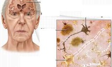 Tuổi tác liên quan đến suy giảm trí nhớ ở nam giới