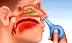 Viêm xoang cấp ở người lớn