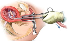 Những tai biến sau nạo phá thai