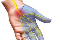 Tê tay chân do dùng thuốc và hướng điều trị